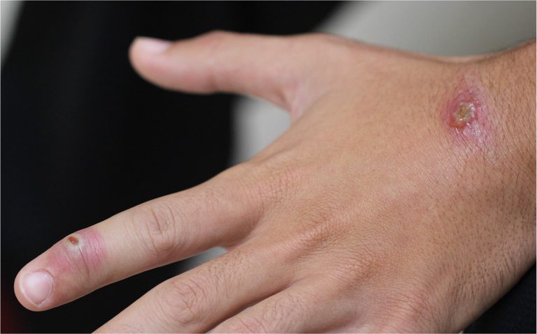 What Is Orf Infection?